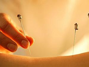 女人针灸治疗臀部疾病,针灸治疗免疫系统疾病