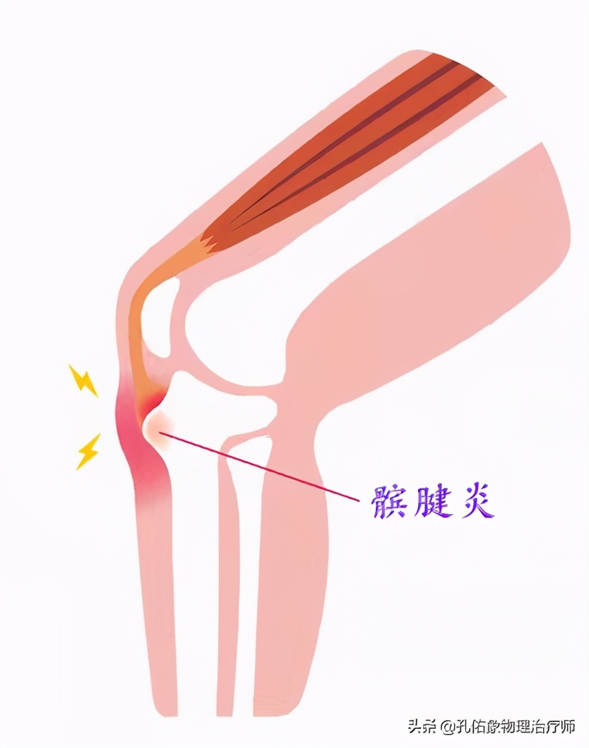 膝关节疼痛位置判断得了什么病,膝关节疼痛一般什么原因引起的