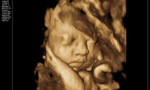 四维彩超图片孩子少一块,四维彩超图看孩子准确