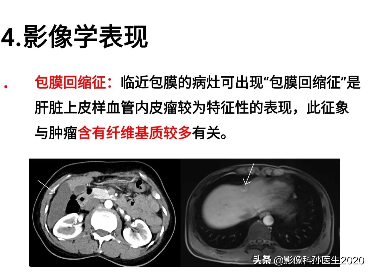 肝上皮样血管内皮瘤全国多少例,肝上皮样血管内皮瘤超声表现