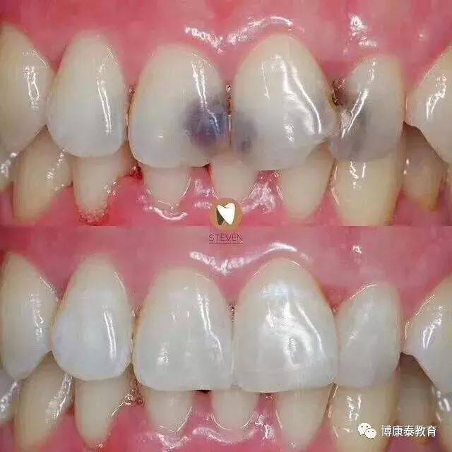 牙齿掉了一半是补牙还是植牙,牙齿烂了为什么不能拔