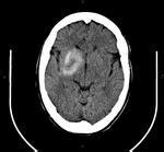 脑出血与造影剂渗漏怎么鉴别,脑血管介入术宣教视频