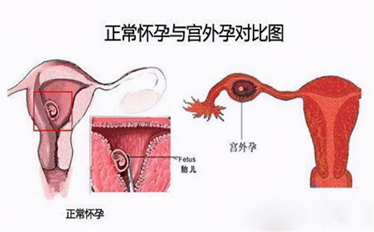 宫外孕切除输卵管会有什么后遗症,宫外孕为什么医生建议输卵管切除