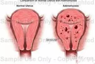 子宫腺肌症最怕的克星,有子宫腺肌症吃的中药吗