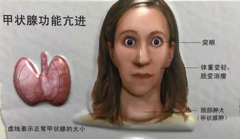 甲状腺相关性眼病临床上有家族聚集性的特征，是一类多基因遗传病