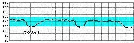 胎心监护宫缩曲线图怎么看,胎心监护有时候出现宫缩怎么办