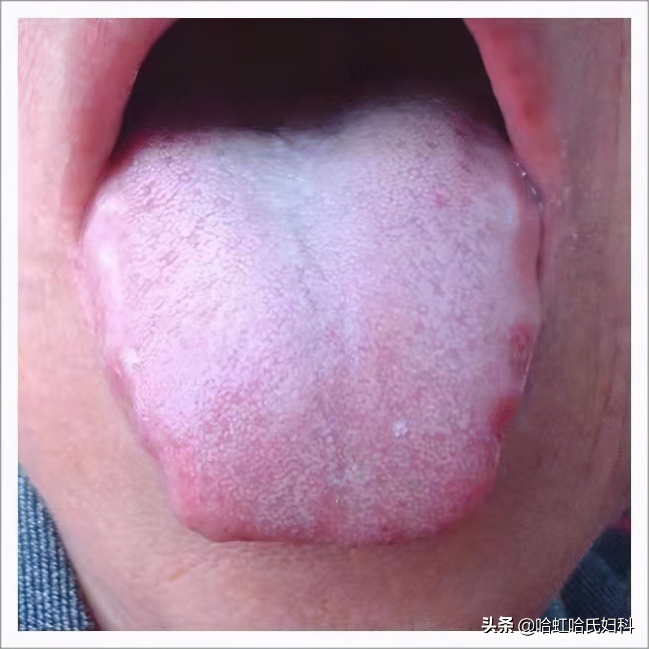 中医的五种方式告诉你是否脾虚,一招教您判断体内湿气