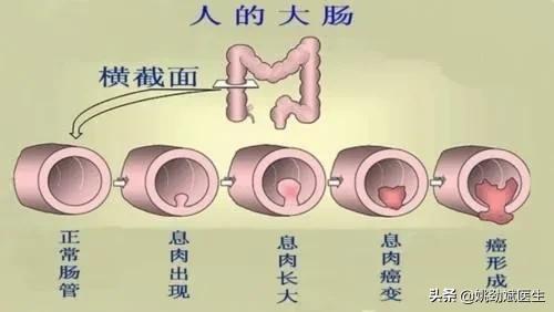 哪些疾病可使得肛门脱出呢？