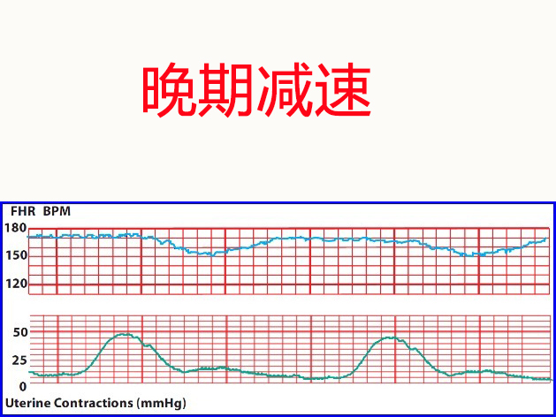 胎心监护图分析,胎儿胎心监护有减速是怎么回事