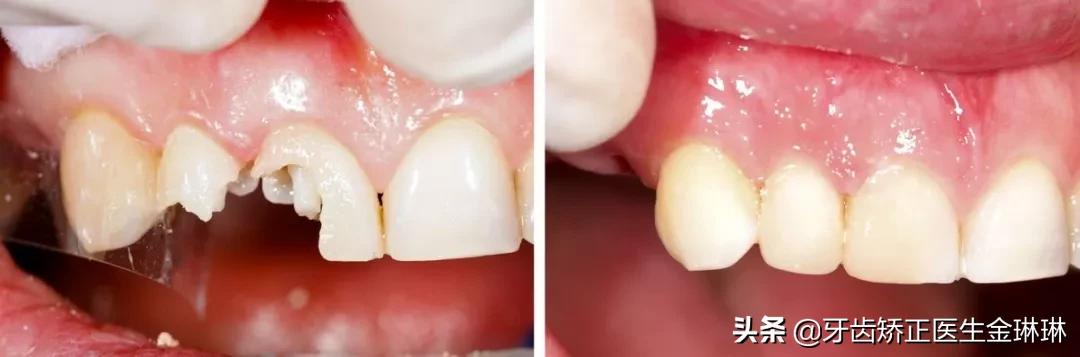 「淄博诺尔漫齿科」缺牙、补牙，你掉进这5大坑了吗？