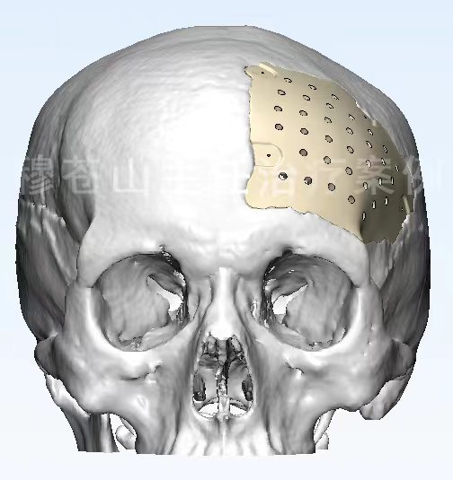 头骨缺失是什么原因,头骨不修补有什么后遗症
