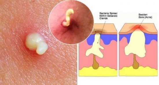 个别痘里面有白脓能挤吗,脓包型痘痘如何排出脓液