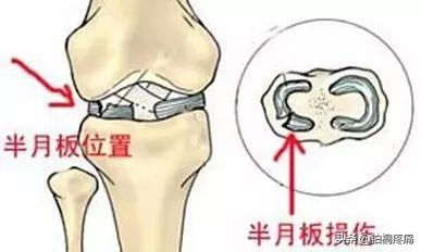 女人膝盖疼痛警惕四种病因,膝盖内侧疼痛的病因