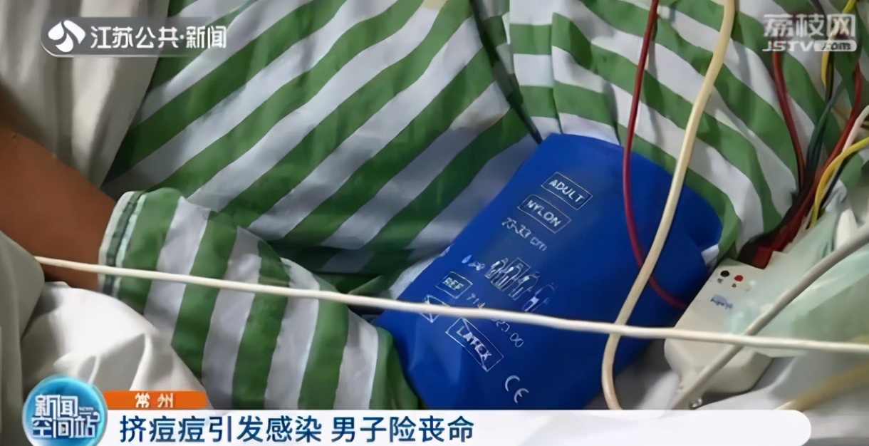 男子挤痘痘住院,男子挤痘痘引发肺部严重感染