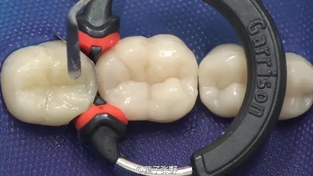 补牙疼吗补牙过程图,补牙全部过程是什么样子的