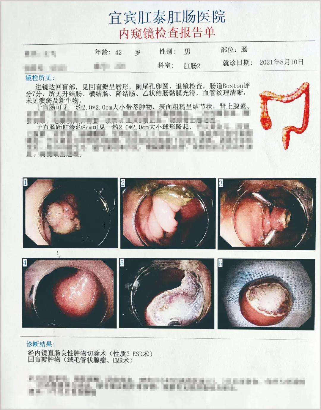 42岁男子行肠镜检查，竟查出二种瘤