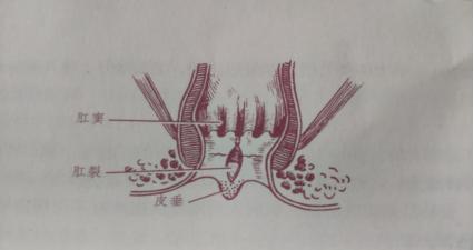 肛裂每次大便都血淋淋,肛裂致死