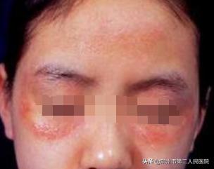 得了皮肌炎，挂号是挂皮肤科？