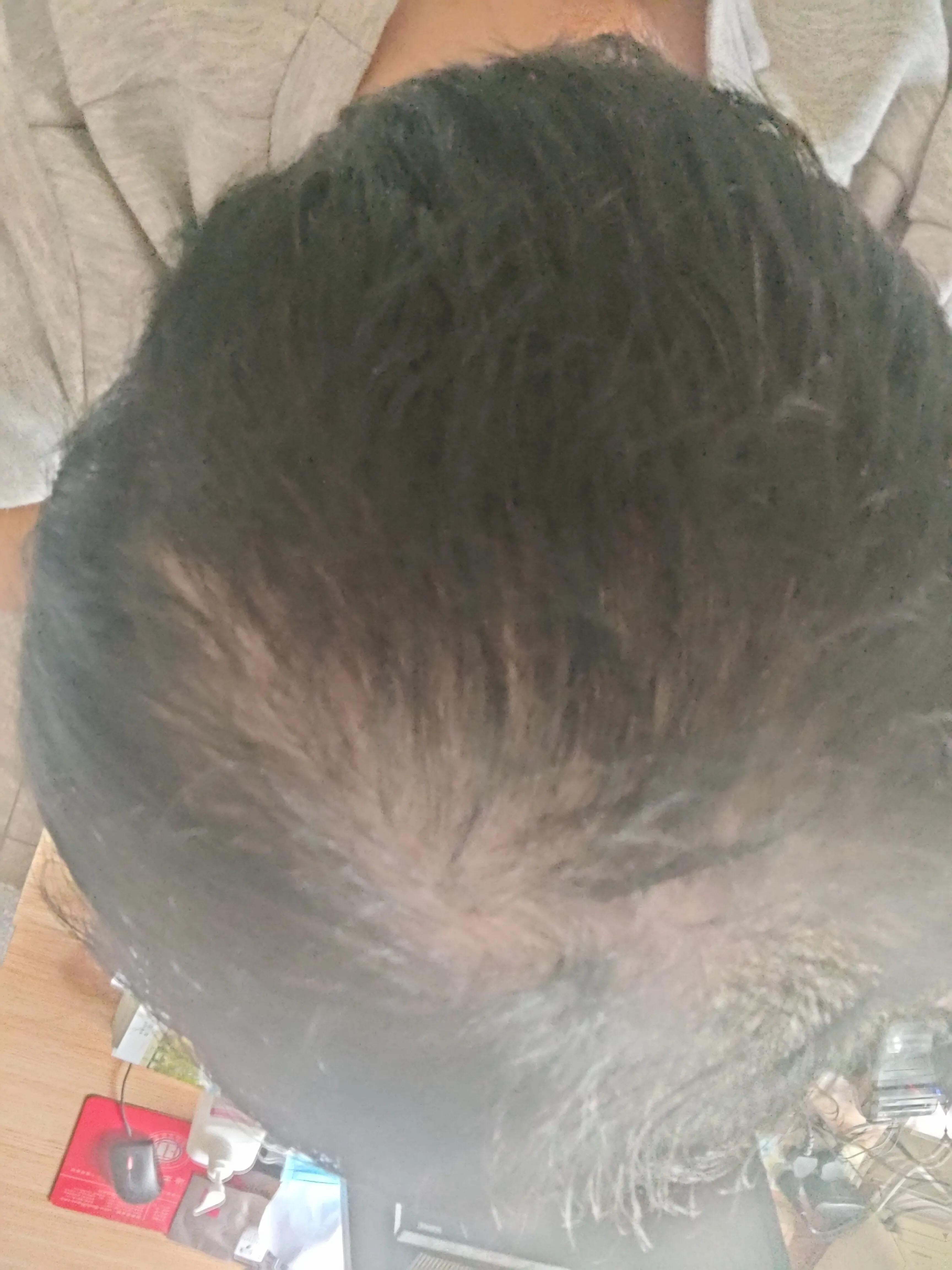 中医脱发挂哪个科室,脱发中医看哪个科室