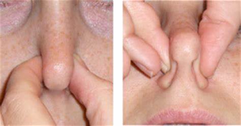 专业医生：冬季鼻出血就得这样处理，请收下这篇健康科普