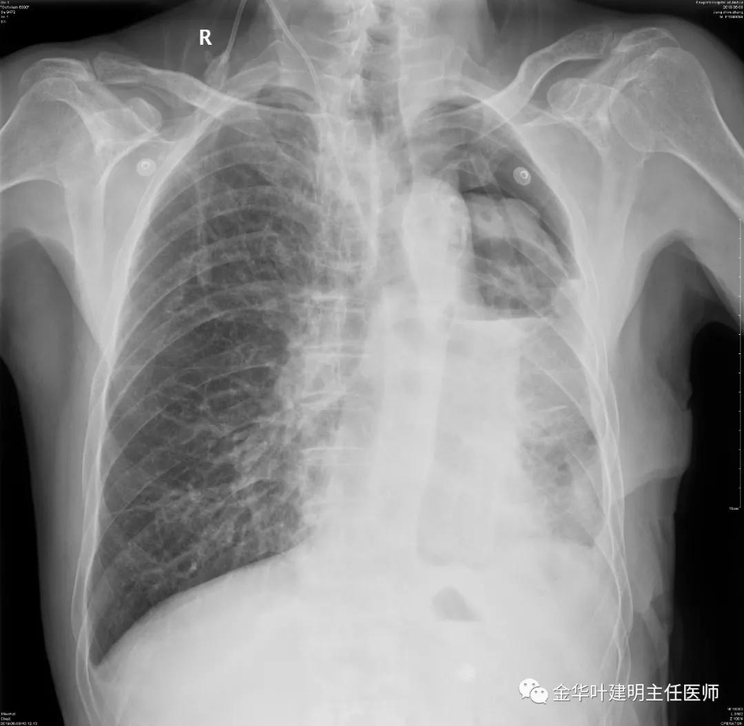 肺手术后乳糜胸是医疗事故吗,肺部切除后乳糜胸治好了