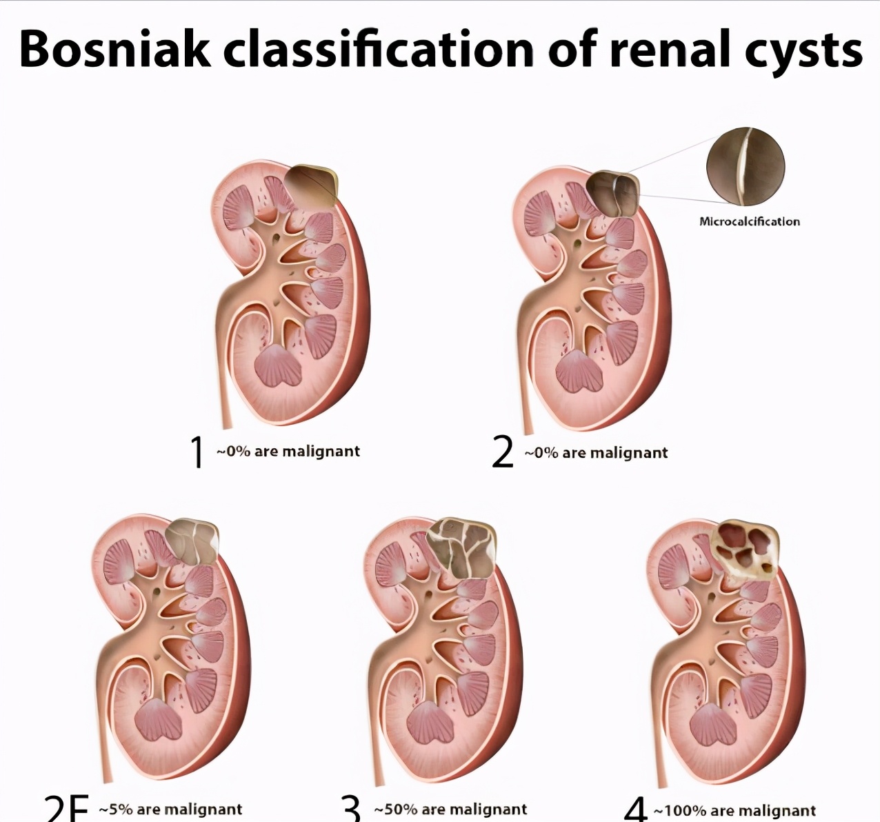 肾囊肿到底是怎么回事啊严不严重,了解肾囊肿最佳治疗方法是什么