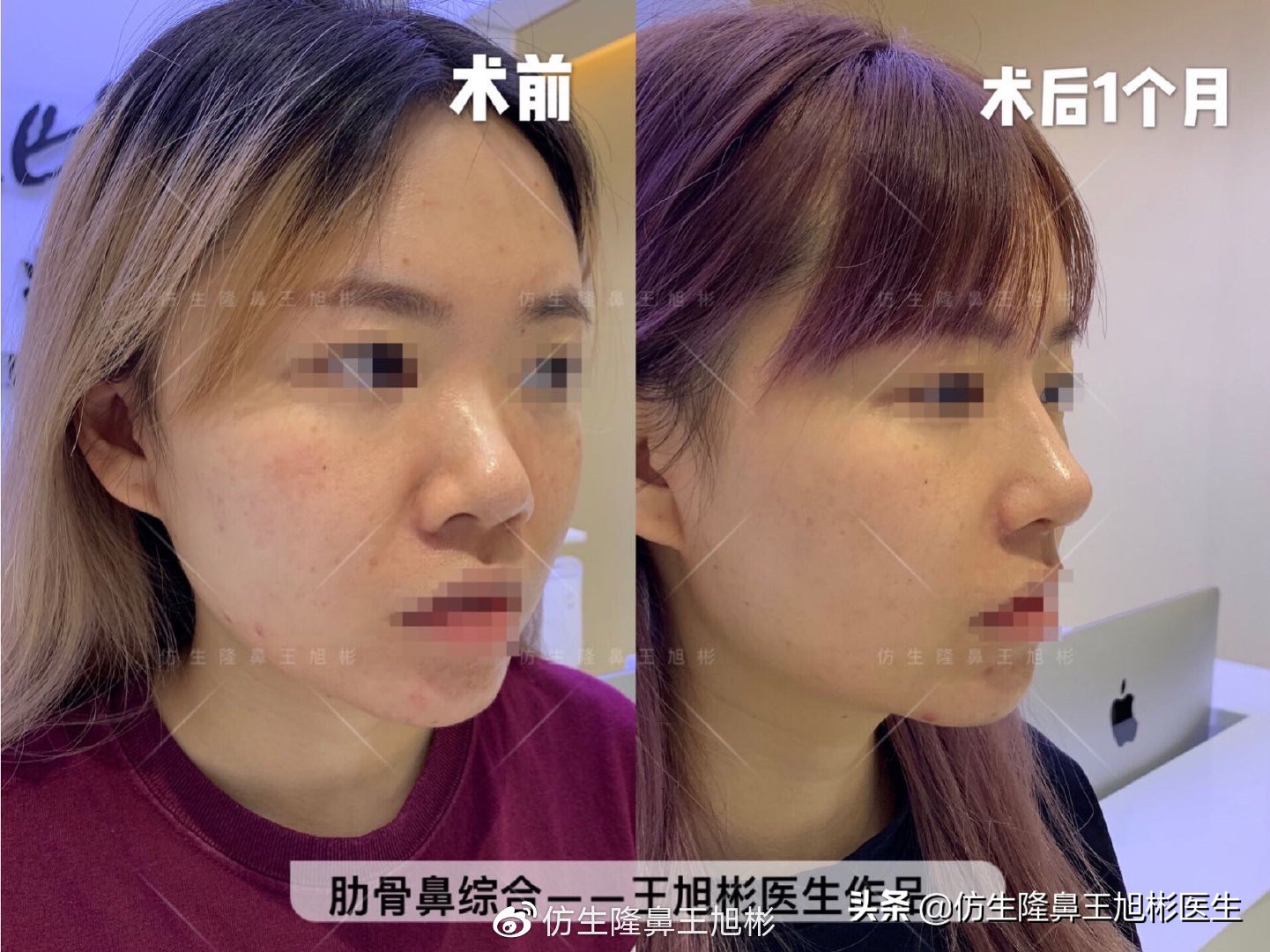 那些被鼻子“封印”颜值的鼻综合/修复案例|广州鼻整形