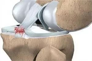 十字韧带断裂多久手术最佳,前交叉十字韧带断裂康复