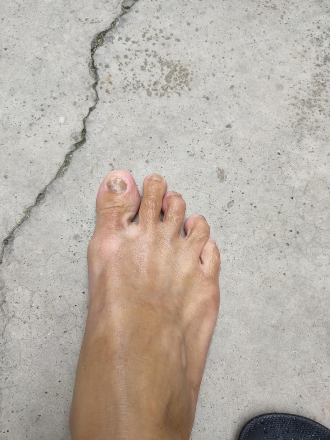 干燥敏感皮肤夏天怎么护理,夏天脸部皮肤脱皮干燥怎么办