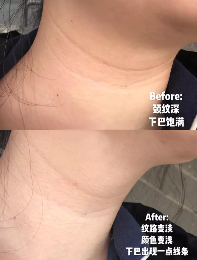 有颈纹和没有颈纹的女人,女人有颈纹怎么办