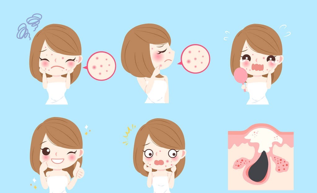 玫瑰*疮痤**患者机体免疫调节的异常，该病发病率显现逐年上升的趋势