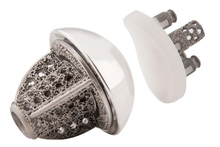 激光3D打印无茎肩关节植入物