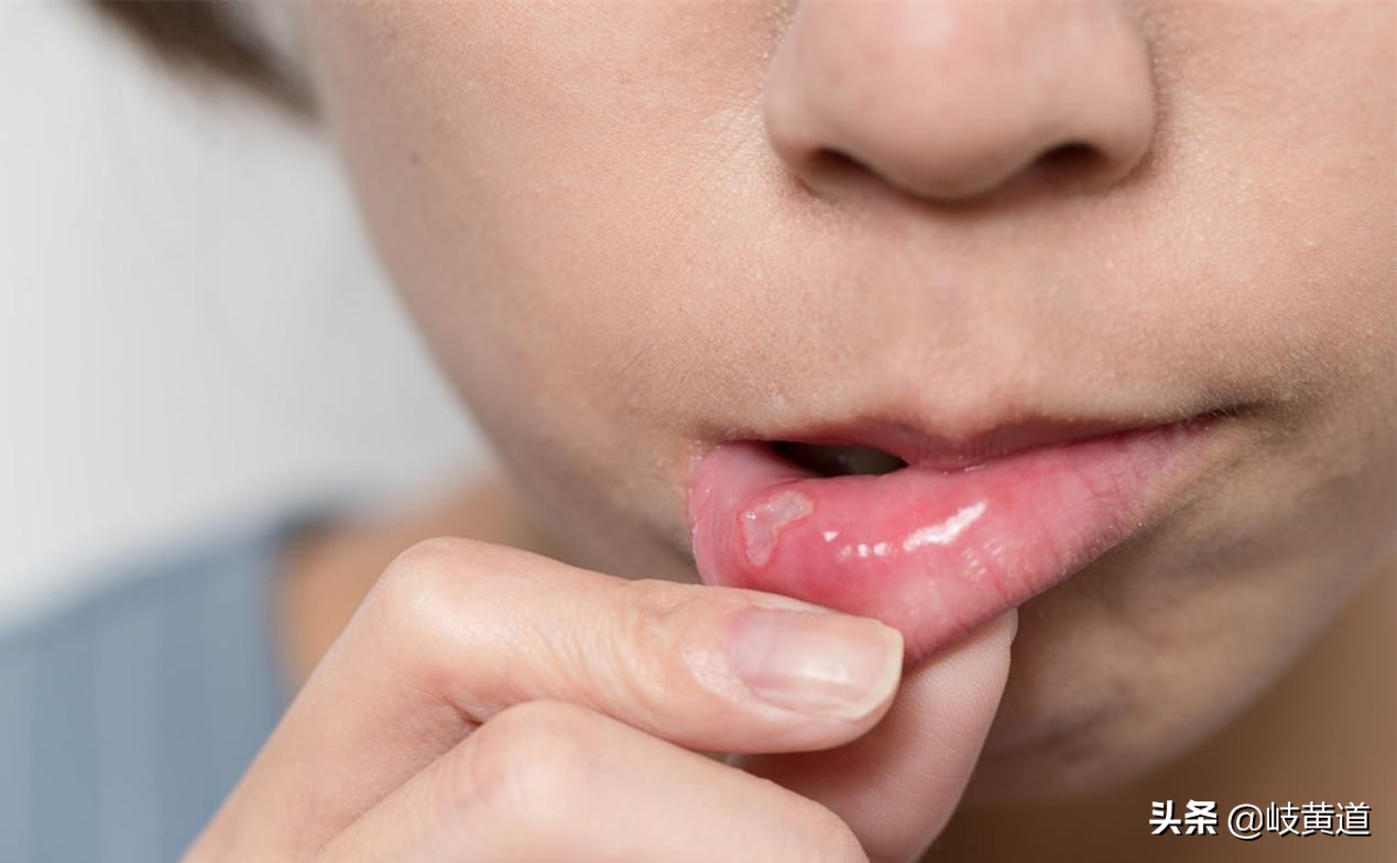口腔溃疡是缺锌还是缺维生素b,口腔溃疡缺维生素b2还是b12