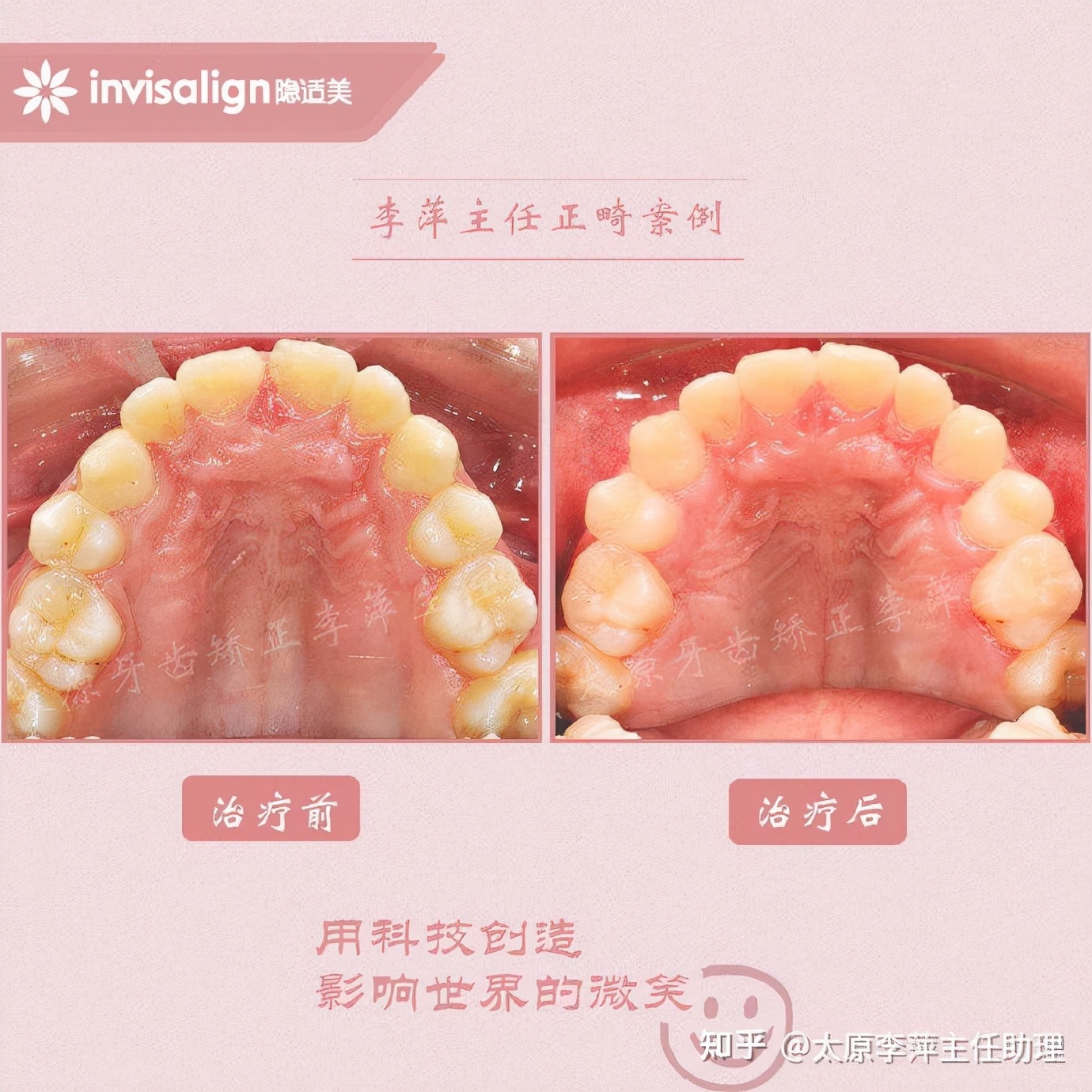 太原牙齿矫正靠谱吗,太原成人隐形牙套牙齿不齐