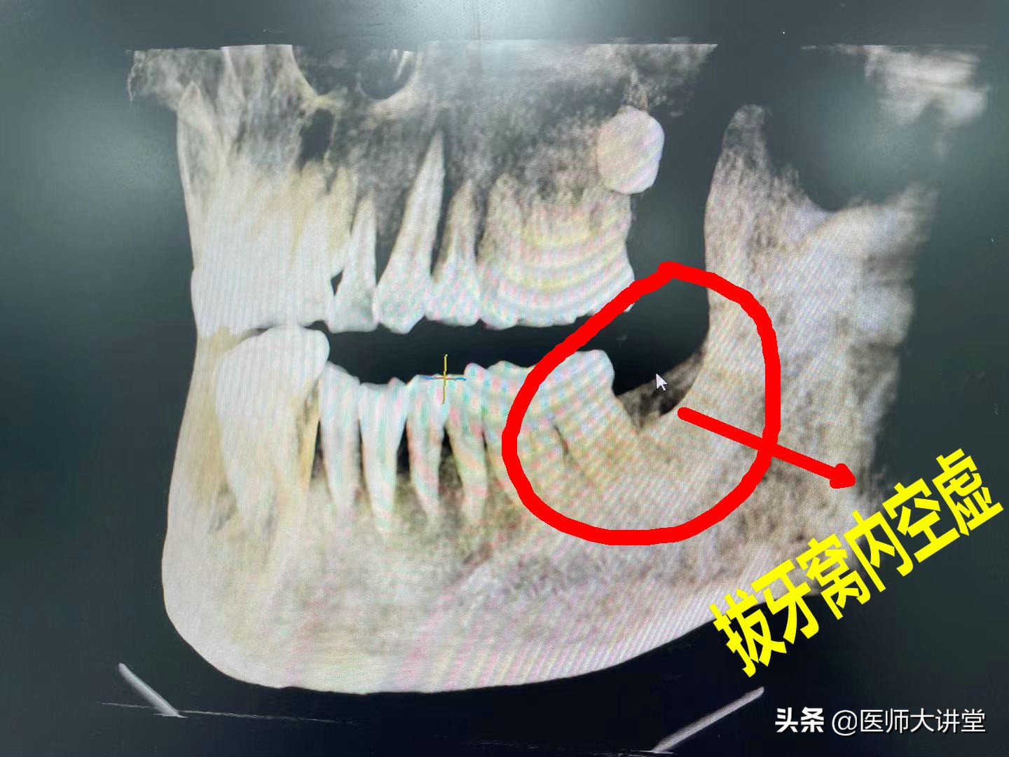 探讨56岁刘大姐拔除立事牙15天后疼痛肿胀的原因分析