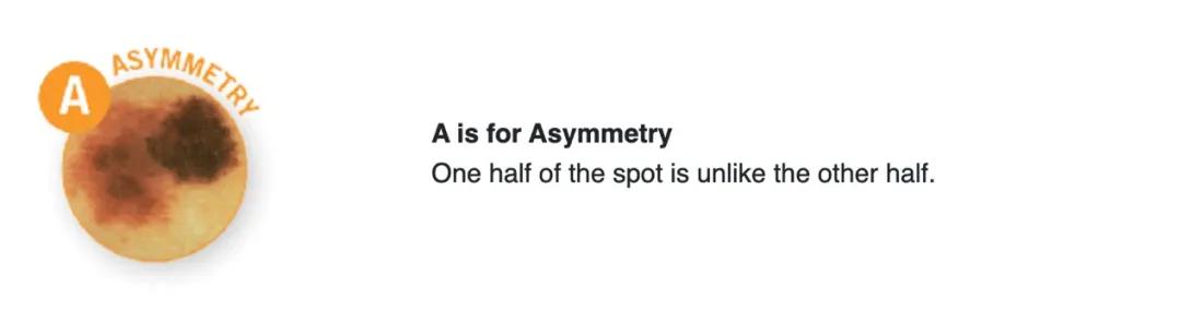 宝宝刚长出来的痣怎么消除,婴儿先天的痣容易癌变