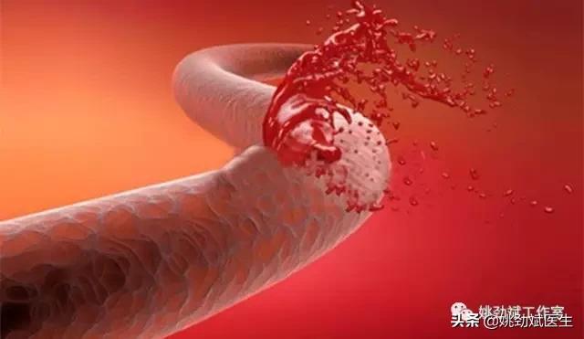 大便带血鲜红不痛应关注什么,大便带鲜血不疼痛