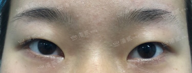 开眼角为什么分内眼角和外眼角,开眼角之后反而变丑了