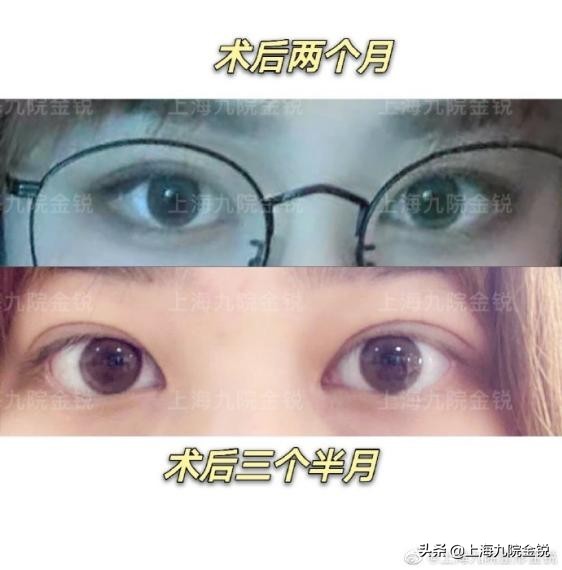 双眼皮VS单眼皮，为什么更多人喜欢双眼皮？