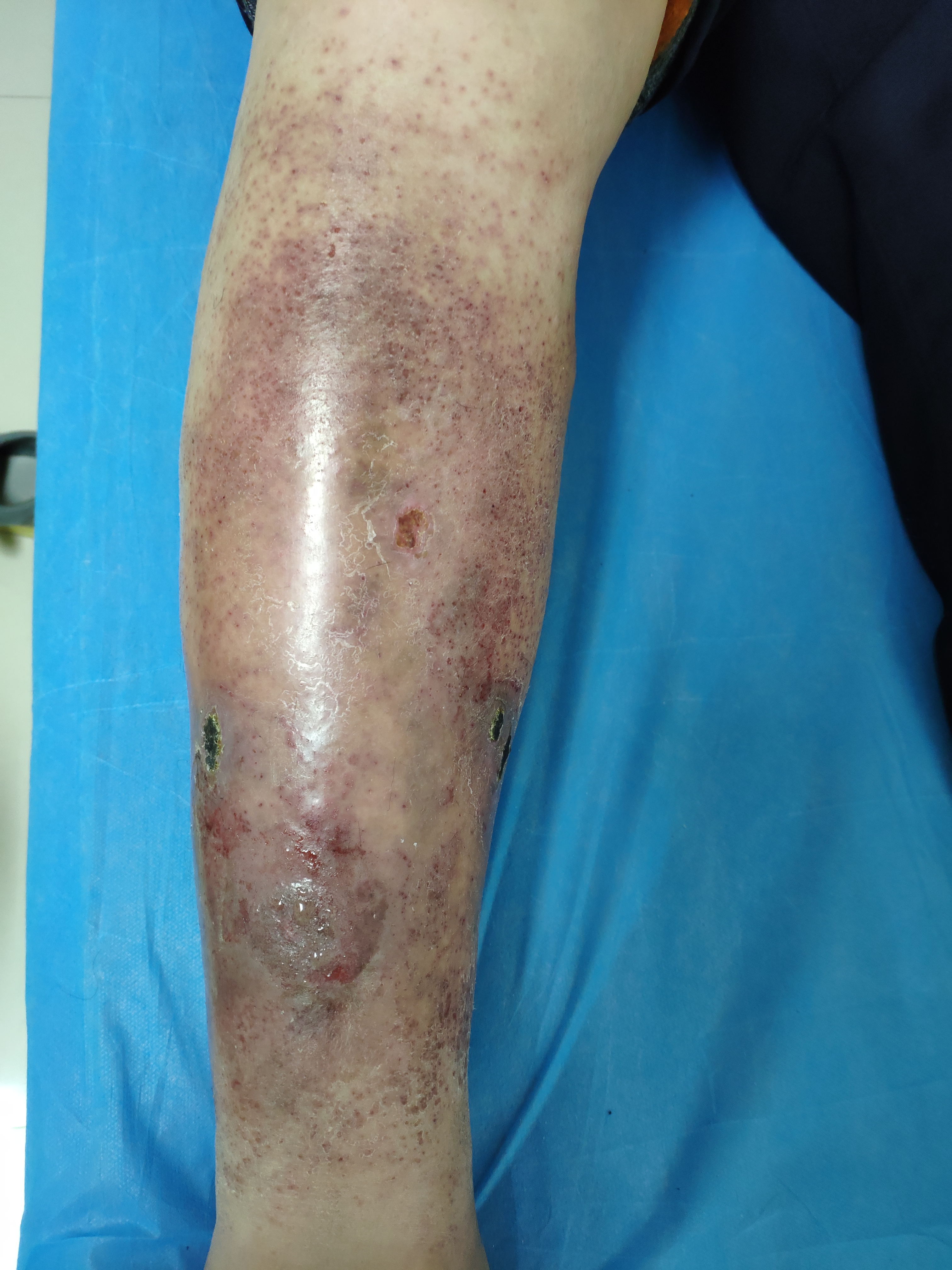 皮肤溃烂挂骨外科主要看什么病,皮肤溃烂看中医还是西医