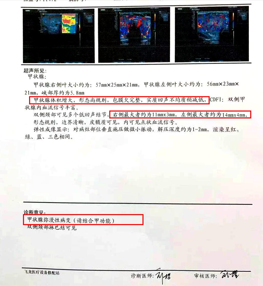 甲亢感觉眼睛有一点点突算严重吗,甲亢从刚突眼到严重需要多长时间