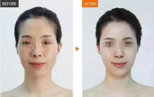 人衰老面部变化,面部衰老改善最好的方法