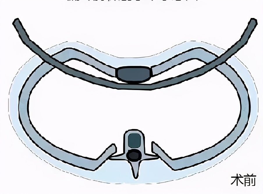 胸前肋骨两侧凹陷属于漏斗胸吗,胸口凹陷一个小坑一定是漏斗胸吗