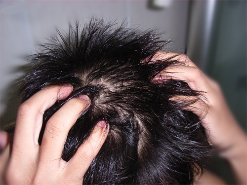 头皮痛而且脱发严重是怎么回事,头皮红起皮伴有脱发