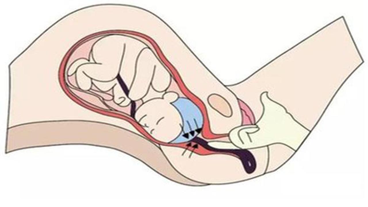 孕妈突然脐带脱垂，胎儿险些缺氧而亡，医生：孕妇平时要关注这4点