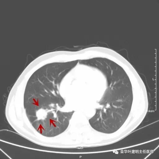 伴有脑转移了的肺癌能手术吗？