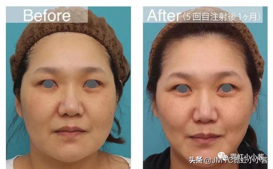 日本小姐姐针灸瘦脸视频,小姐姐打瘦脸针视频