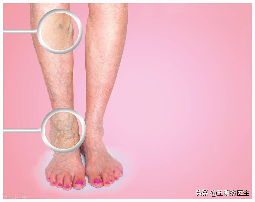 下肢静脉曲张溃疡了怎么办,如何治疗下肢静脉曲张溃疡发黑