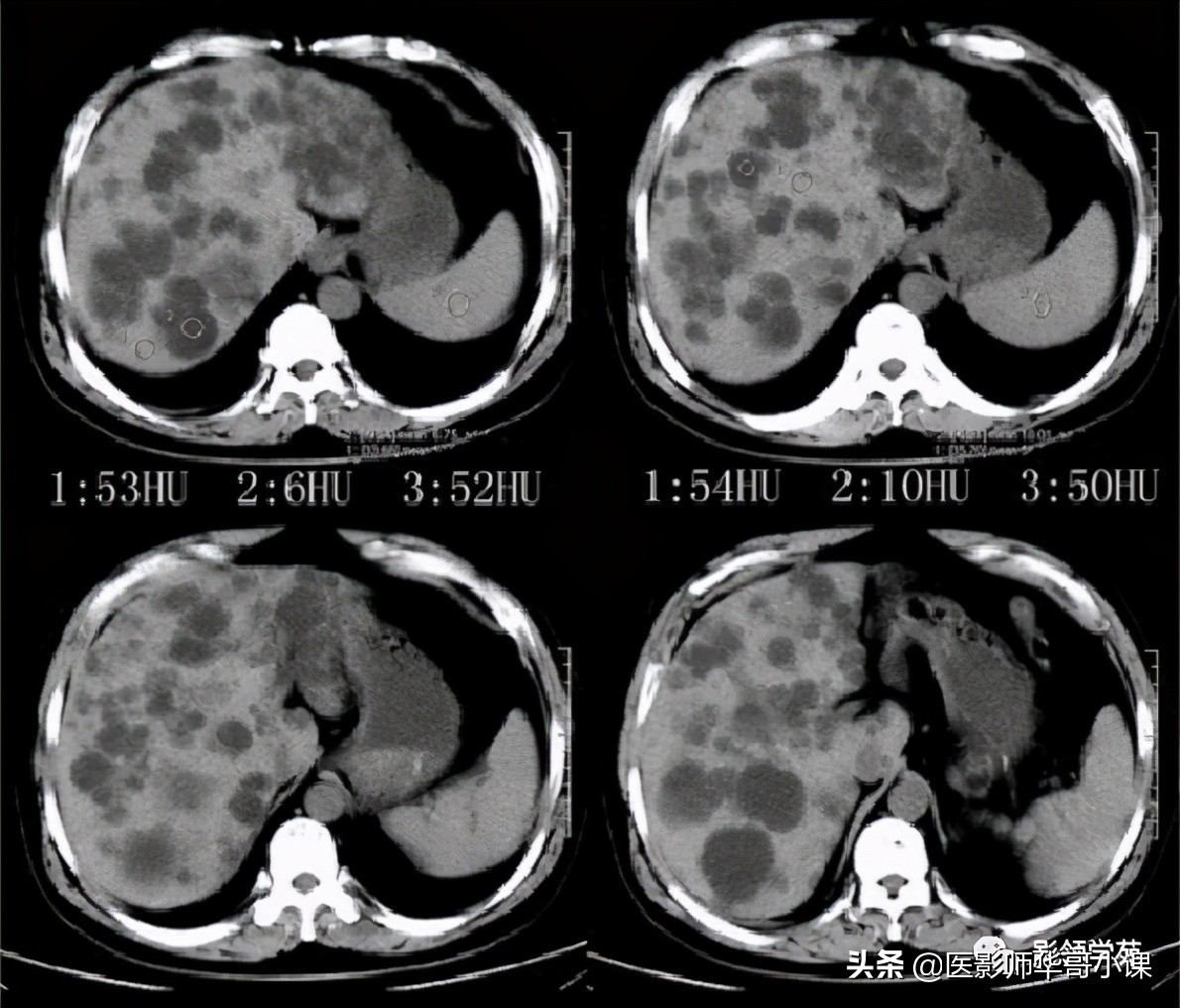 胆总管变异,胆胰管解剖