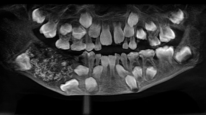 印度男孩嘴里拔出526颗牙齿,印度一男孩嘴巴里取出许多牙齿